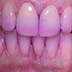 口腔护理界奇葩物牙菌斑显示剂，带你徒手一览牙菌斑现形记
