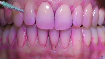 口腔护理界奇葩物牙菌斑显示剂，带你徒手一览牙菌斑现形记