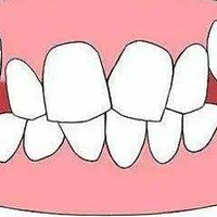 牙齿不整齐能用电动牙刷吗？牙医提醒三大弊端！