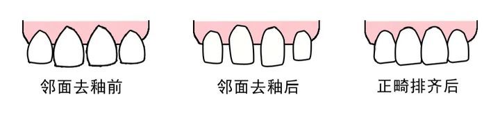 隐形正畸期间牙齿惊现“黑三角”！专家：矫正前做好牙周清洁很关键！