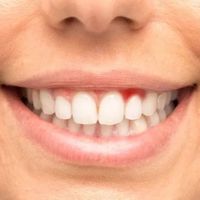 是谁在说牙龈出血吃维生素C就行了？侃侃什么真正的技术才能真的制得住“它”？