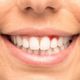  是谁在说牙龈出血吃维生素C就行了？侃侃什么真正的技术才能真的制得住“它”？　