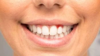 是谁在说牙龈出血吃维生素C就行了？侃侃什么真正的技术才能真的制得住“它”？