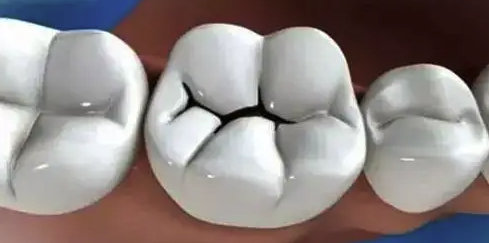 虫子牙？牙疼？关于补牙的一切都在这里！内含3M树脂各型号介绍