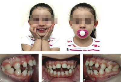毁掉孩子颜值的7 个习惯：口呼吸、打呼噜、吃手、咬唇…一定要尽快改！
