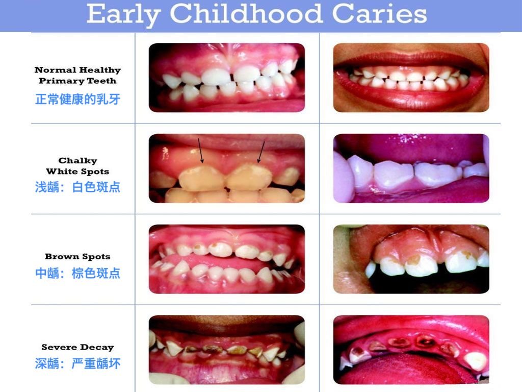 儿童换牙齿顺序图 儿童换牙齿时间-万县网