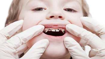 儿童龋齿率超7成，乳牙龋坏要治疗！6招有效防龋，给孩子一口好牙～