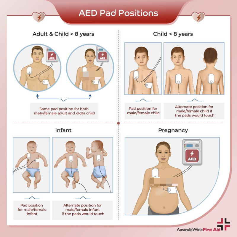 详细图解：儿童心肺复苏术+AED使用指南，家有孩子一定要看！