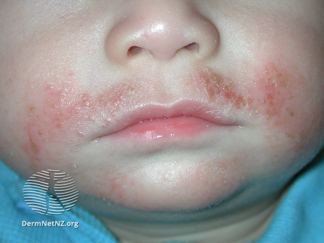 宝宝湿疹反反复复，美国湿疹协会推荐，秋冬保湿这样做！