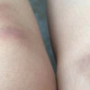为什么女生的膝盖老是青一块紫一块的？