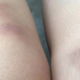 为什么女生的膝盖老是青一块紫一块的？
