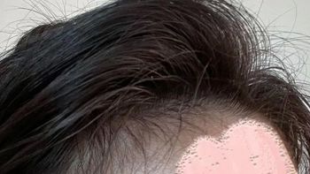 使用米诺地尔治疗脱发的经验总结，秃头女孩又可以了！