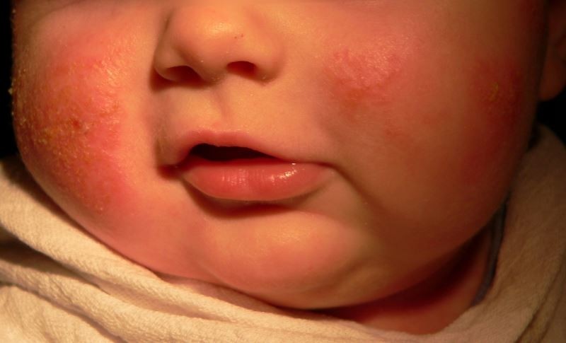 宝宝湿疹反反复复，如何有效护理？从这3点来入手！
