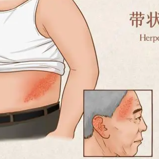 全国首针接种完成！一针管10年，国产带状疱疹疫苗全国接种正式启动