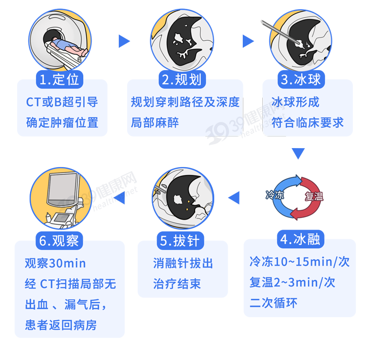 一针“冻死”癌细胞？这种抗癌新疗法可治疗多种肿瘤，费用或只需2万
