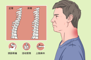 一个合适的枕头缓解颈椎生理曲度变直