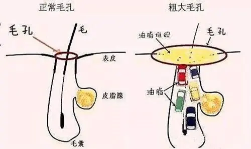 昔日韩国花美男肿成猪刚鬣，脸上挂着二斤油！差点成为其中一员，还好我去油有方！