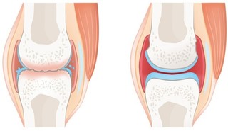 关节炎防治