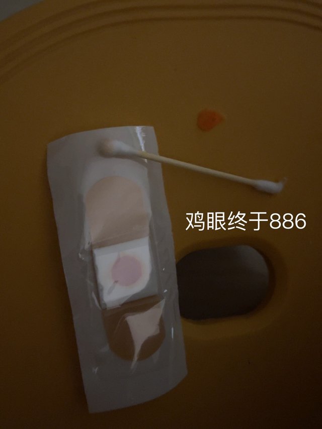 鸡眼两天搞定，这个药挺好