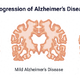天生抵御阿尔茨海默病， 阿尔茨海默病有救了吗？