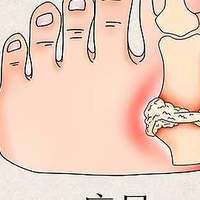 风友该如何应对痛风，学会这样做少受罪？心三源健康