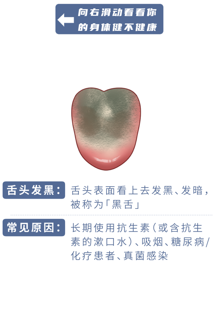 身体好不好，看舌头就知道！若舌头出现这6种情况，当心是疾病信号
