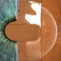 不能做激光类近视手术，角膜薄又是高度近视怎么办？