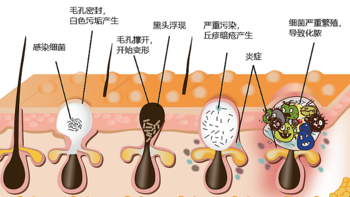 科学护理痘痘肌，告别“痘”争岁月！