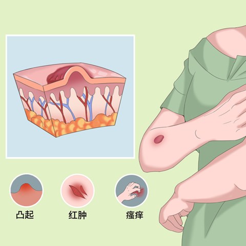 疤痕增生的影响与治疗