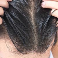 “头”等大事 篇十三：用这个方法让你头发不易出油！头皮敏感、油扁塌、头屑头痒也能得到解决~