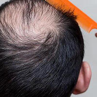 头顶头发稀疏怎么恢复？警告12大头发护理陷阱害处！