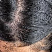 头皮屑特别多是什么原因？提防11大头发养护禁忌害处！
