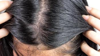 头皮屑特别多是什么原因？提防11大头发养护禁忌害处！