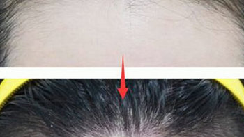 怎么让发际线长回来？11大发质护养内幕危害，需严防！