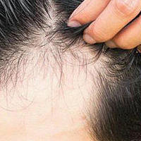 脂溢性脱发怎么护理？10大最容易中招的护发风险套路！