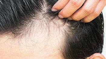 脂溢性脱发怎么护理？10大最容易中招的护发风险套路！