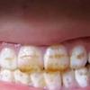 健康养生 篇六：牙粉到底能不能去牙黄？重度牙黄真实经验分享！