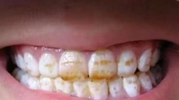 健康养生 篇六：牙粉到底能不能去牙黄？重度牙黄真实经验分享！ 