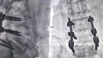 脊柱专科领域黄山首例！黄山新晨医院完成了“天玑”机器人辅助微创脊柱手术