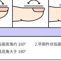 手指出现这个变化，小心是身体发出的危险信号！