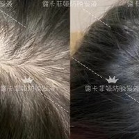 后天头发稀疏，安利排名第一的防脱生发产品，掉发严重速进