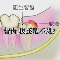 智齿，拔还不拔？这真是一个令人纠结的事儿😫历经三年，我终于拔掉了智齿~