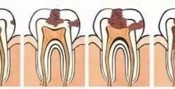 口腔科普 I 牙齿烂了一半，为啥不能补牙？