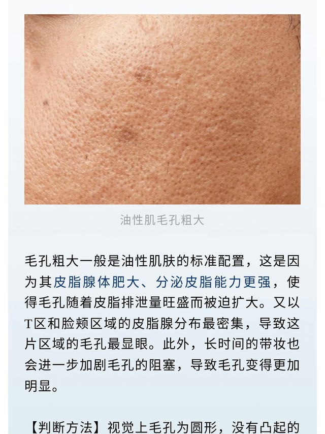 #毛孔粗大的改善思路##毛孔粗大的4种类型# 其实毛孔粗大分很多类型，不同形状、特征有不同的改善方式。来看看你是哪一种👇1️⃣ 油脂分泌型毛孔特征：T区尤其明显，油光满面，毛孔呈圆形。改善方式：控油是