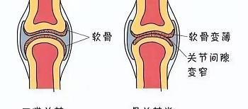 Jarrow氨糖软骨素——为关节健康保驾护航