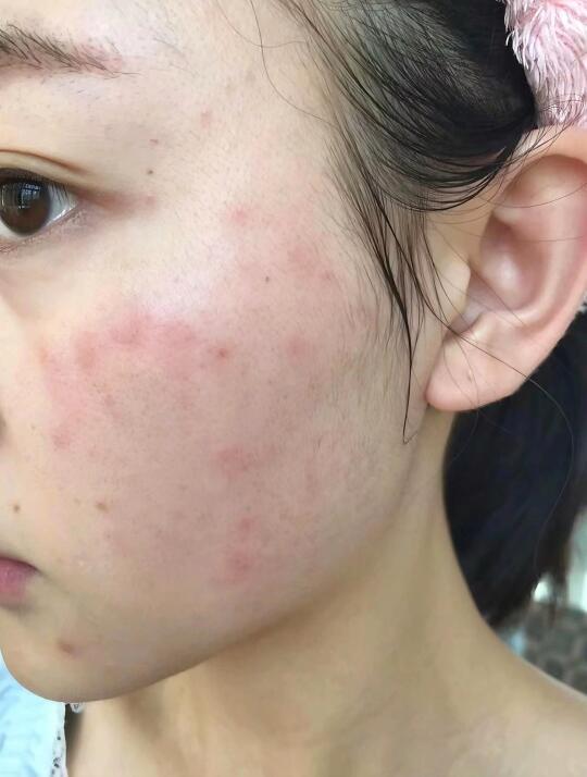 频繁打水光的代价……