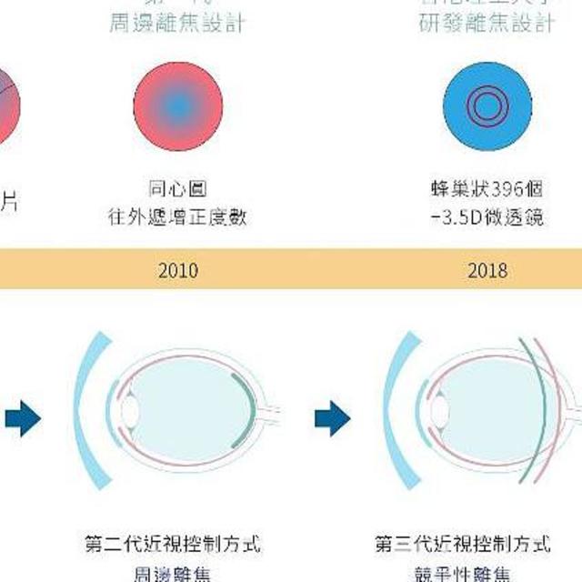 家有近视小孩？别忽略控制期！快速了解近视控制原理与技术演进