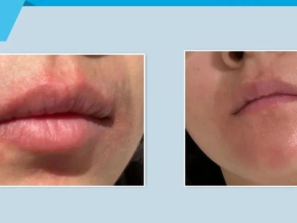 女明星吃米饭会爆痘，你吃水果嘴巴红痒，原因竟是…