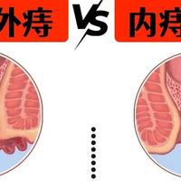 1秒自测，看看你属于内痔还是外痔！痔疮肉球最佳改善方法！