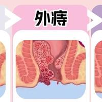 痔疮逐渐消失的3大阶段! 得了痔疮怎么办？痔疮治疗最佳方法！